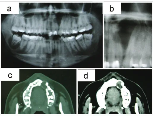 Fig. 1. (a) Panoramic radiograph showed osteolytic lesion in a peak-like shape, in the zone  between the upper lateral incisor and canine
