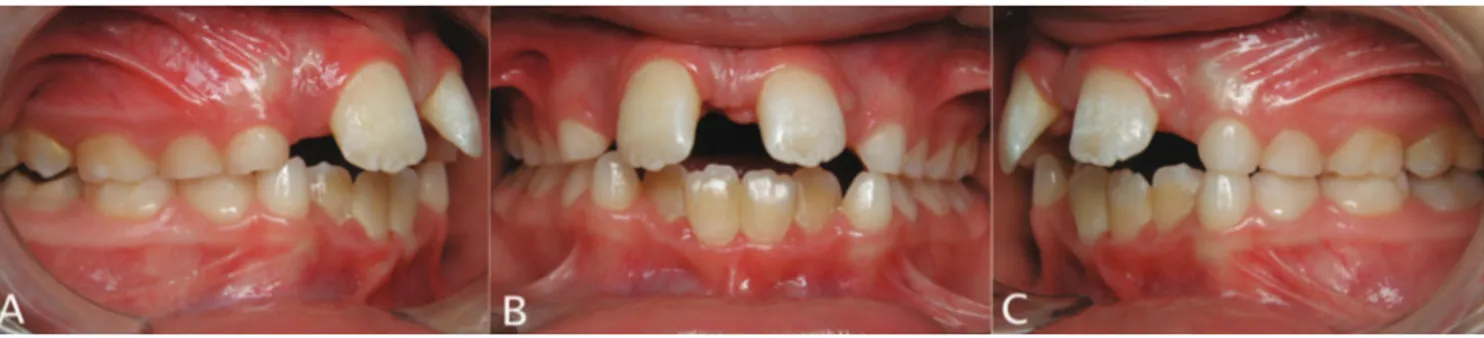 Fig. 2. Intraoral photographs taken at two-month treatment to show the initial clinical progress: A) frontal view; B) right side view; 