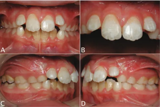 Fig. 5. Post-treatment intraoral  photographs: A) frontal view;  