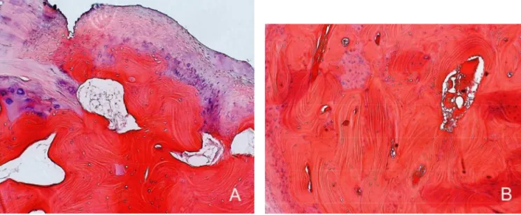 Fig. 3. Bone scintigraphy scan showing an abnormal activity in  the left TMJ.