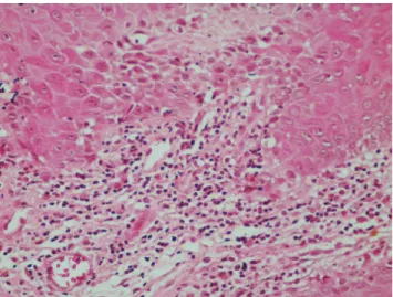 Fig. 2. Photomicrograph showing a lymphocytic infiltrate in  band-like pattern (H-E staining x 200).