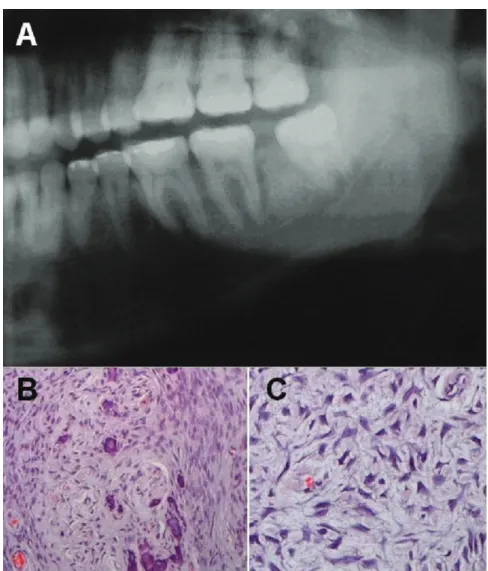 Fig. 1. (A) Panoramic radiograph   detail showing a diffuse radiopaque  image with ill-defined borders   between 37 and 38 teeth and  thickening of the pericementary space  of the distal 37 tooth root