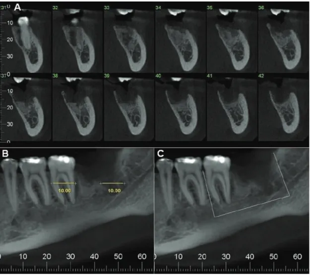 Fig. 4. (A) Panoramic CT  reconstruction after tumor  resection. (B) and (C) Oral  and occlusal clinical aspect  in 18 months post operative  follow-up.