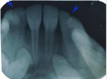 Fig.  1.  Clinical  aspect  of  the  bilateral  fusion  of  mandibular  primary lateral incisor and canines forming a single large tooth  on both right and left sides (shown with black arrows).