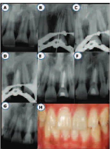 Fig. 1. (A) Radiographic aspects of apical third root resorption  observed in the tooth (21)