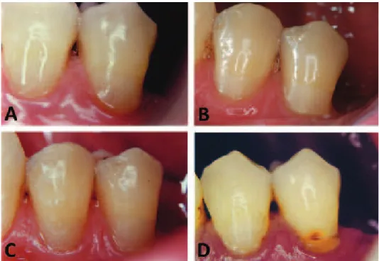 Fig. 3. Vestibular view of restoration  of teeth 34 and 35 after 1 week (A),  18 months (B), 36 months (C) and  48 months (D)