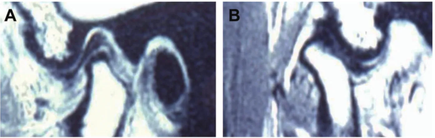 Fig. 1. Subluxation: (A) mouth closed; (B) mouth opened.