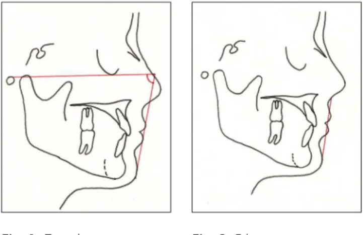 Fig. 2. E line measurement.