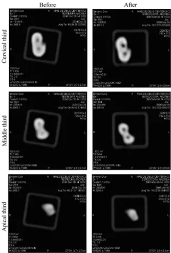 Fig. 1. Axial slices of the cervical, middle, and apical thirds,  before and after preparation of the root canal walls.