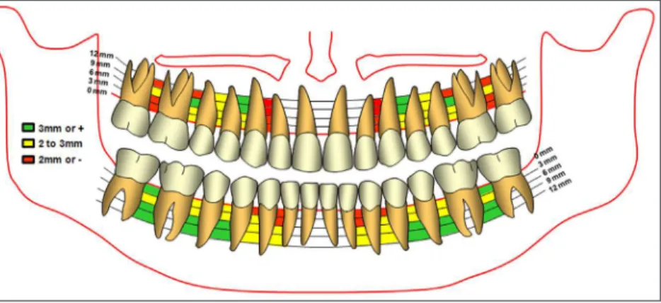 Table 1 shows that the largest amount of interradicular  bone in the mandible  was found between the irst and second  molars (4.48 mm, ±1.69) at a height of 11 mm from the bone  crest,  and  we  therefore  considered  this  the  safest  area  for  miniscre