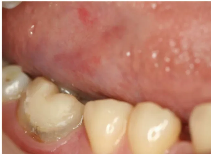Fig.  1. A  direct  view  of  the  reddish  and  depapillated  sites  in  tongue  in  case  1