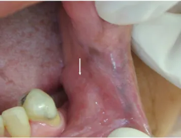 Fig.  4.  Three  months  following  amalgam  replacement  by  composite  resin,  the  partial  remission  of  the  lesions  can  be  notice in buccal mucosa (arrow) and near of labial commissure