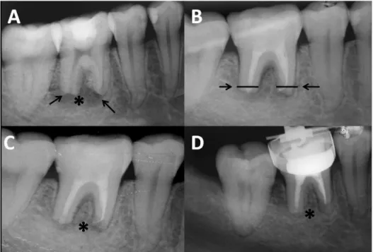 Fig. 2. Case 2. (A) tooth 46  with open apexes (arrows) and  extensive radiolucent area (*); 
