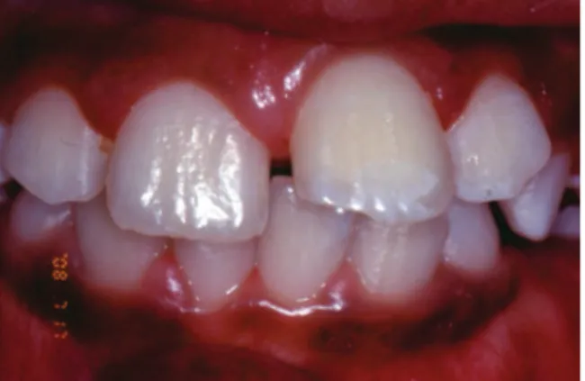 Fig. 4. Clinical examination showing complete eruption  of the central incisors.