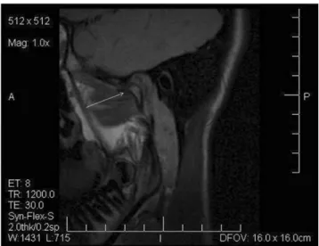 Figure 1 shows a coronal section in which it is possible  to observe asymmetry between both mandibular condyles  (MCs) and erosion of the anterior aspect of the right condyle