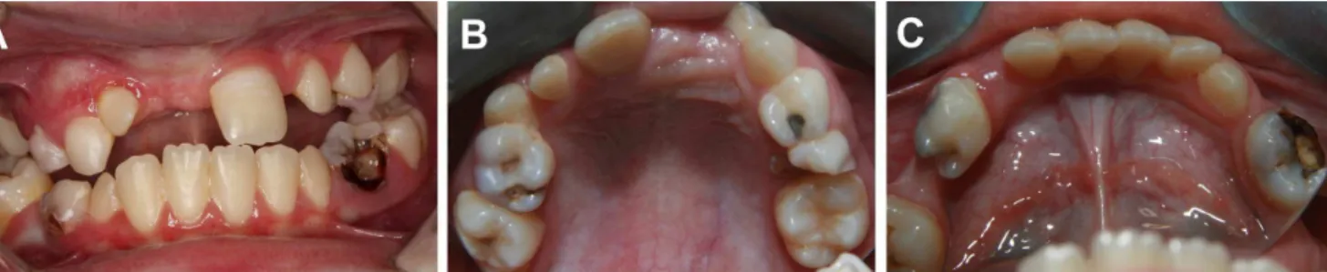 Fig. 2. (A) Frontal view of occlusion shows poor oral health, with many carious lesions and gingivitis, particularly in the region of the  maxillary right lateral incisor, and large amount of dental plaque