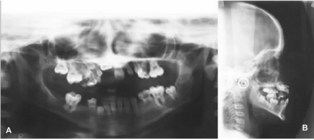 Fig. 3. (A) Panoramic x-ray shows  impacted teeth and dental agenesis. 