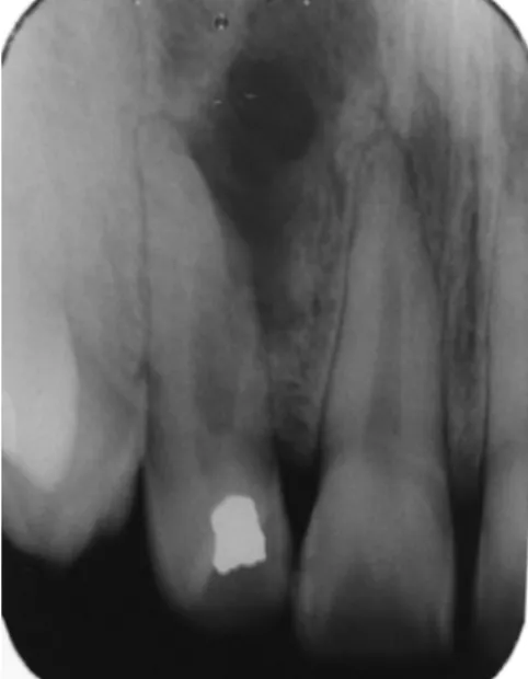 Fig. 1. Initial radiograph: extensive  radioluscent area, laterally to the tooth,  suggestive of a chronic apical periodontitis