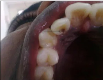 Fig. 2. Tooth 22 showing an accessory cusp   on the lingual surface (arrow).