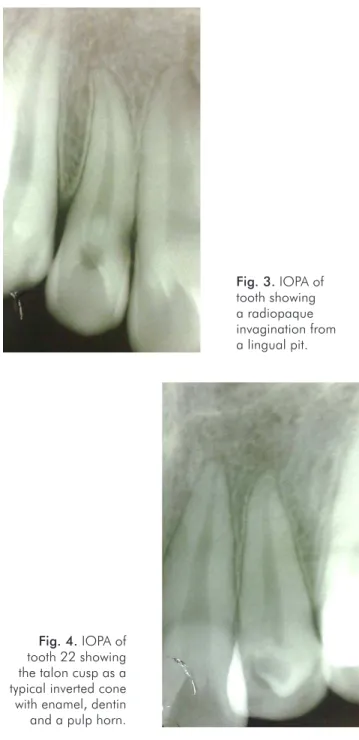 Fig. 4. IOPA of   tooth 22 showing  the talon cusp as a  typical inverted cone  with enamel, dentin  and a pulp horn.