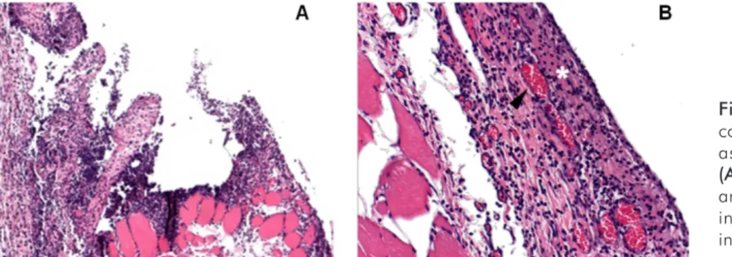 Fig. 2. Reaction of rat subcutaneous  connective tissue to 0.9% sterile saline  associated with infected dentine
