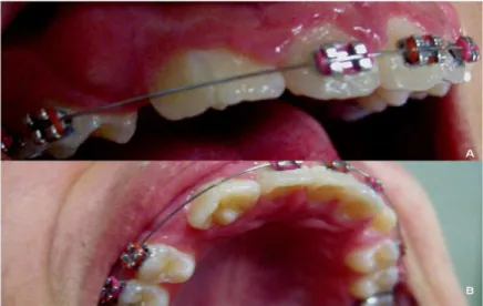 Fig. 1. Clinical view. A) Vestibular view of fused crown of tooth 12 and 13.  