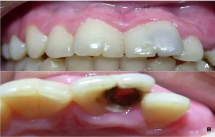 Fig. 4. A) Radiograph showing the   extensive pulp chamber of element 21.  