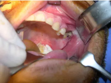 Fig. 1. Intraoral view showing a hard yellowish mass associated  with the absence of the posterior molars.