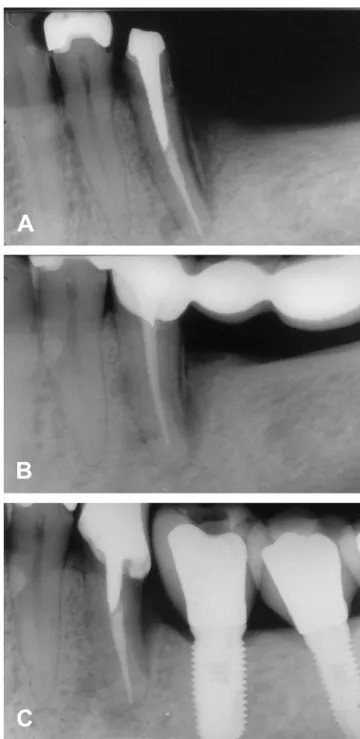 Fig. 1. Periapical radiographs showing: (A) radiopaque aspect  of the distal fragment in the mandibular left second premolar,  suggesting  cemental  tear;  (B)  one  year  before  the  fragment  removal; and (C) satisfactory aspect on the alveolar bone twe