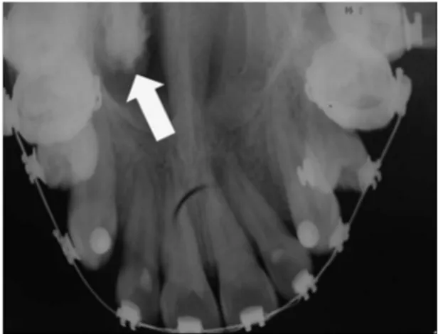 Fig. 3. Occlusal radiograph of the maxilla, showing  a well-defined ovoid radiopaque image in the nasal  cavity on the right side (indicated by the arrow).