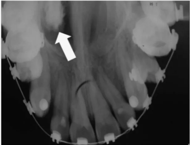 Fig. 3. Occlusal radiograph of the maxilla, showing  a well-defined ovoid radiopaque image in the nasal  cavity on the right side (indicated by the arrow).