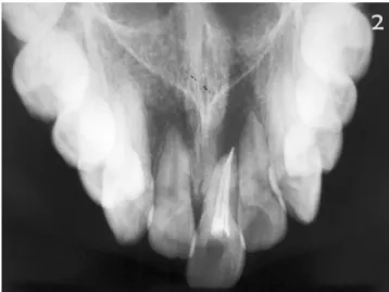 Fig.  2.  Maxillary  occlusal  radiography  revealed  a  history  of  unsuccessful root canal treatment on tooth 21 and the absence  of tooth 11.
