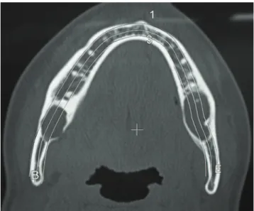 Fig. 5. Computerized tomography,  dental arch reconstruction, bone window,  exhibiting both lesions.
