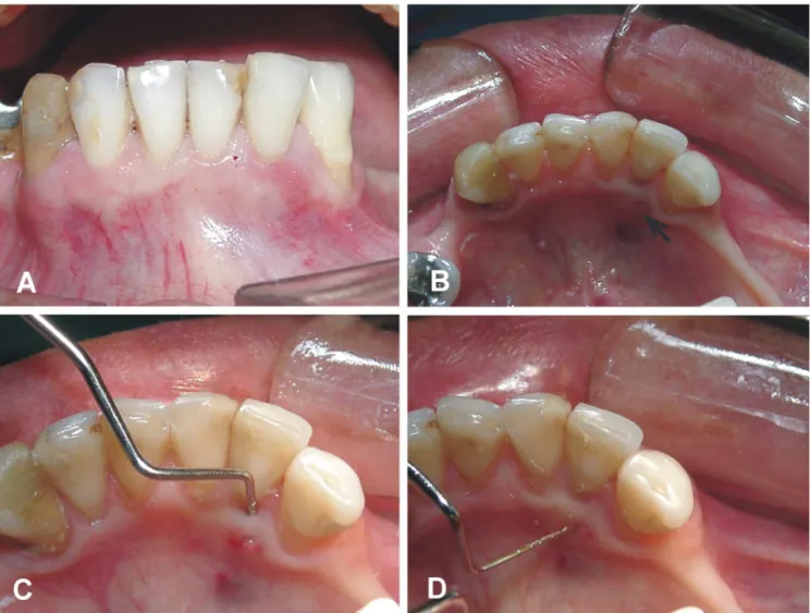 Fig. 1. Clinical examination:  (A) mandibular left lateral incisor in supra-occlusion; (B) distolingual fistula (arrow); (C) periodontal  pocket probing; (D) horizontal fistula probing.