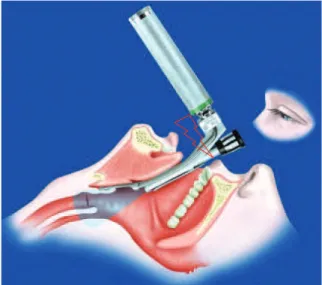 FIGURA  1  -  A  utilização  do  laringoscópio  nos  procedimentos  de  anestesia  e  preparo  do  paciente  para  intubação  durante  a  cirurgia  pode  levar   acidental-mente (seta) ao traumatismo dentário, especialacidental-mente nos incisivos superior