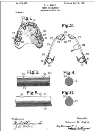 FIGURA 1 - Arco-E de Angle (apresentado em 1900 e patenteado em 1901) já  propagava a idéia da expansão com o objetivo de se obter espaços no arco  para todos os dentes.