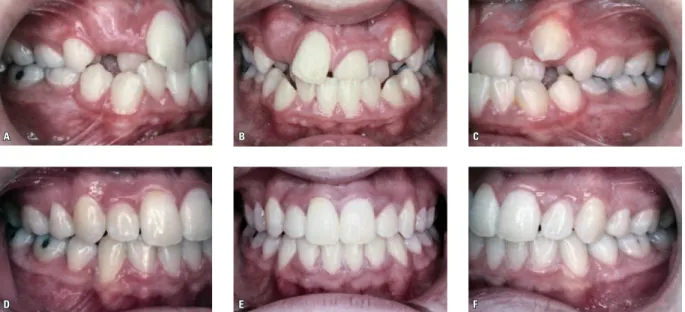 FIGURA 4 - A, B, C) Fotografias iniciais de má oclusão de Classe III com o paciente apresentando-se no final da dentadura mista e com apinhamento severo em  ambos os arcos