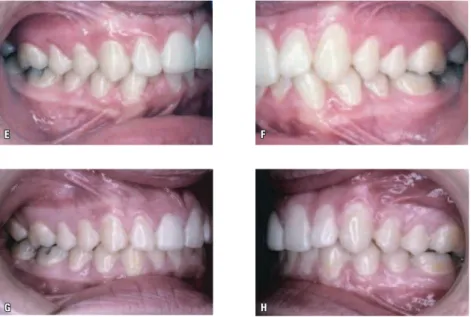 FIGURA 1 - Extração de incisivo inferior em caso com discrepância de tamanho dentário: A, B, E, F) Fotografias  intrabucais pré-tratamento ortodôntico