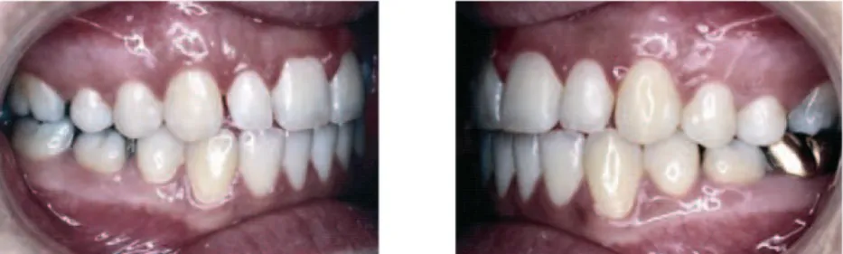 FIGURA 3 - Fotografias intrabucais exemplificando a correção de Classe II dentária com extração dos primeiros pré-molares superiores.