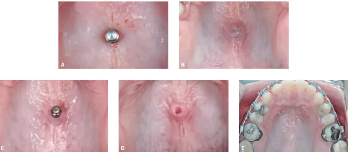 FIGURA 3 - Mini-implante logo após ser inserido no palato duro ( A ) em paciente de 25 anos, usuária de contraceptivo