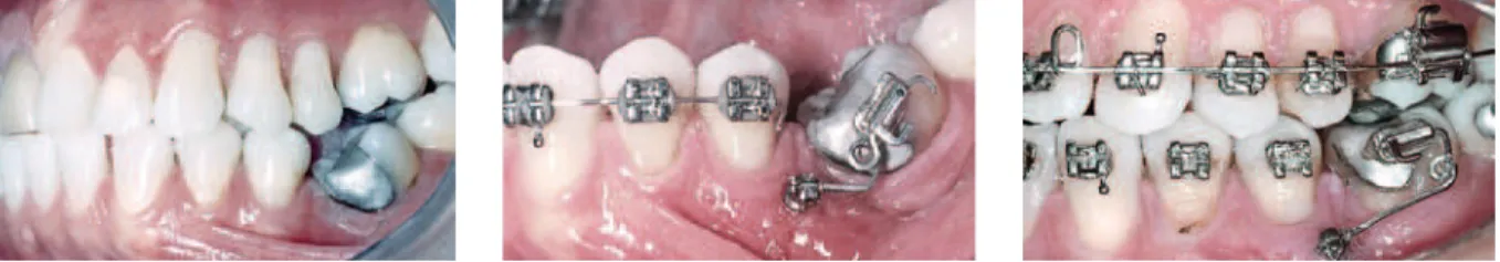 FIGURA 1 - Verticalização de molar, usando mini-implante com cabeça em forma de braquete, com movimento de inserção anti-horário (Dentos Inc., Daegu, Coréia)  (Tratamento efetuado por Dra