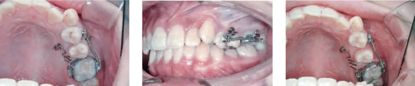 FIGURA 3 - Mini-implantes com cabeça em forma de braquete instalados por vestibular e palatino, para obter distalização dos molares em corpo