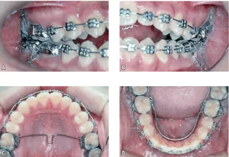 FIGURA 5 - Após o nivelamento, foram colocados mini-implantes entre as raízes dos primeiros e segundos molares nos quatro segmentos (A,  B)