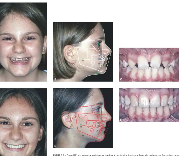 FIGURA 5 - Caso DC: os espaços existentes devido à perda dos incisivos laterais podem ser fechados tam- tam-bém em pacientes com espaços consideráveis e maxila atrésica (A, B, C)