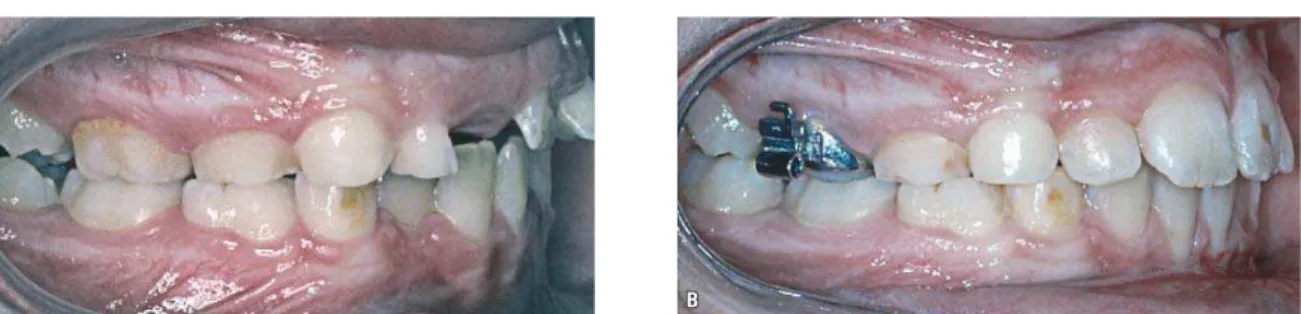 FIGURA 8 - Caso MO: a relação Classe II (A) foi corrigida também nos molares permanentes (B), com aparelhos aplicados nos molares decíduos e com certa coope- coope-ração.