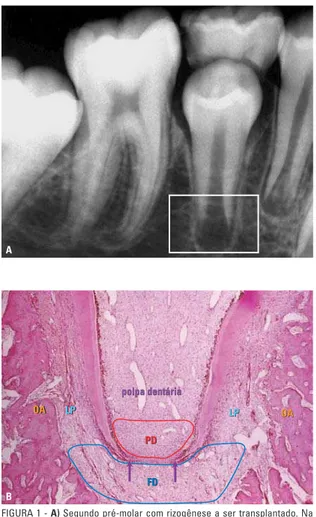 FIGURA 1 - A) Segundo pré-molar com rizogênese a ser transplantado. Na  região apical, a área radiolúcida corresponde aos espaços ocupados pelos  tecidos embrionários responsáveis pela rizogênese (quadrado)
