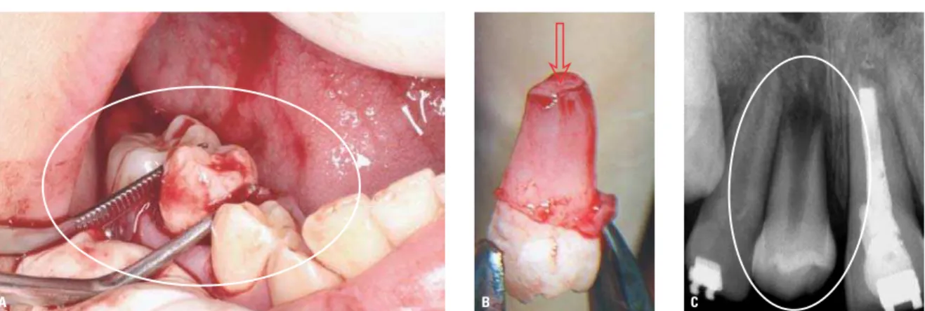 FIGURA 2 - A) Segundo pré-molar luxado e removido para ser transplantado. B) Na região apical do dente removido observa-se um verdadeiro botão de tecido mole  (seta) que corresponde aos tecidos embrionários responsáveis pela rizogênese