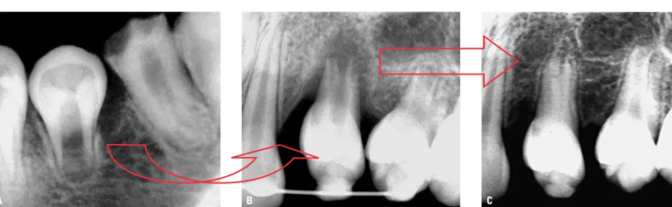 FIGURA 3 - A) Segundo pré-molar inferior transplantado para a região superior. B) O leito receptor alojou adequadamente os tecidos moles periodontais e foliculares  dentários transplantados