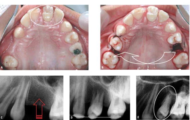 FIGURA 4 - A) Em um primeiro momento, foi realizado o transplante de pré-molar superior para a região de incisivo superior  (círculo) perdido por traumatismo  com fratura, em paciente com indicação ortodôntica de exodontia de quatro pré-molares