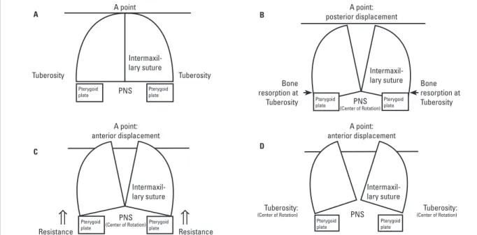 FIGURE 2 - Schematic illustrations of the postulated maxillary displacement after rapid maxillary expansion
